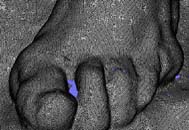 Formf�lschung der Zehen durch Restauration